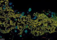 Neuartiges Modell ermöglicht Erforschung individueller Immunreaktionen bei Darmkrebs